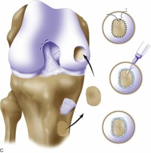 Cartilage Injuries - Shoulder And Knee Clinic