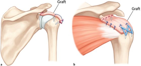 Massive Rotator Cuff Tears And Superior Capsular Reconstruction