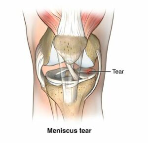 Meniscus Injuries - Shoulder And Knee Clinic