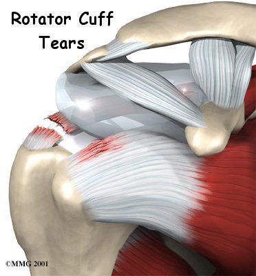 Rotator Cuff Tear - Joint Preservation Center