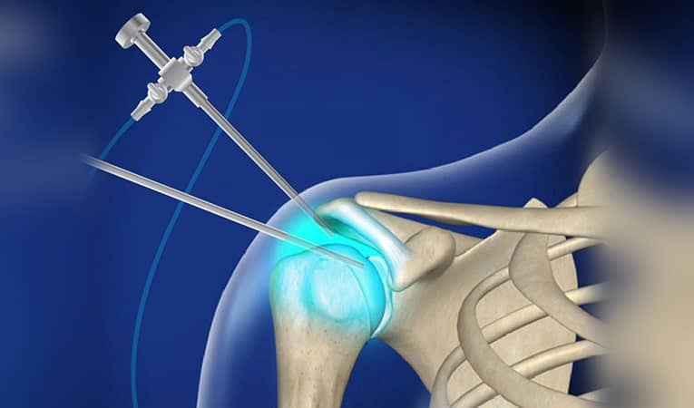 Shoulder Arthroscopic Surgery - Dr. Aditya Sai