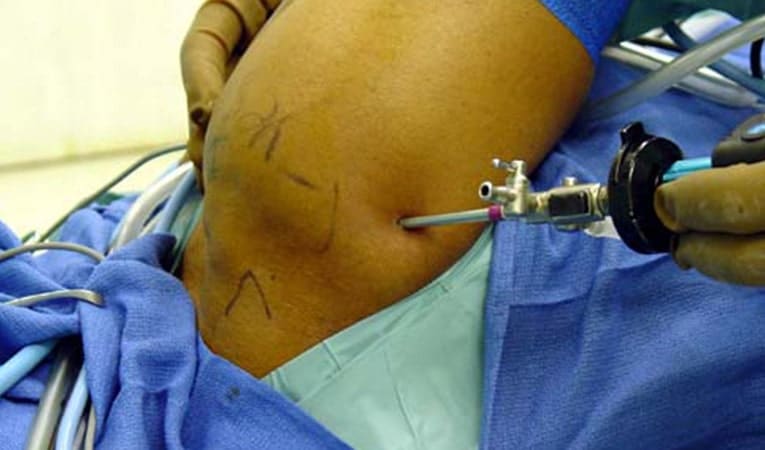 Shoulder Arthroscopic Surgery For Recurrent Dislocation