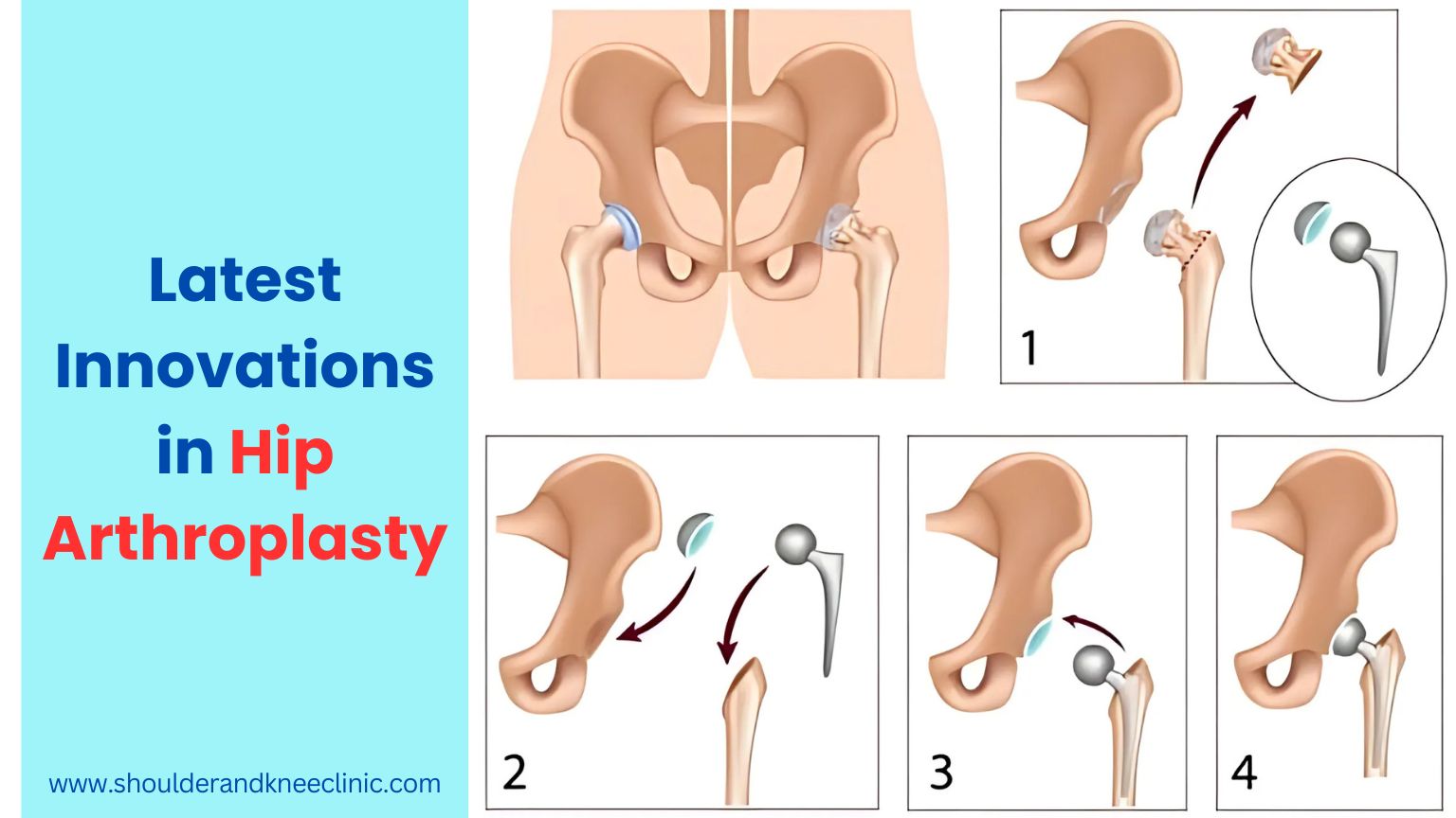 Latest Innovations in Hip Arthroplasty